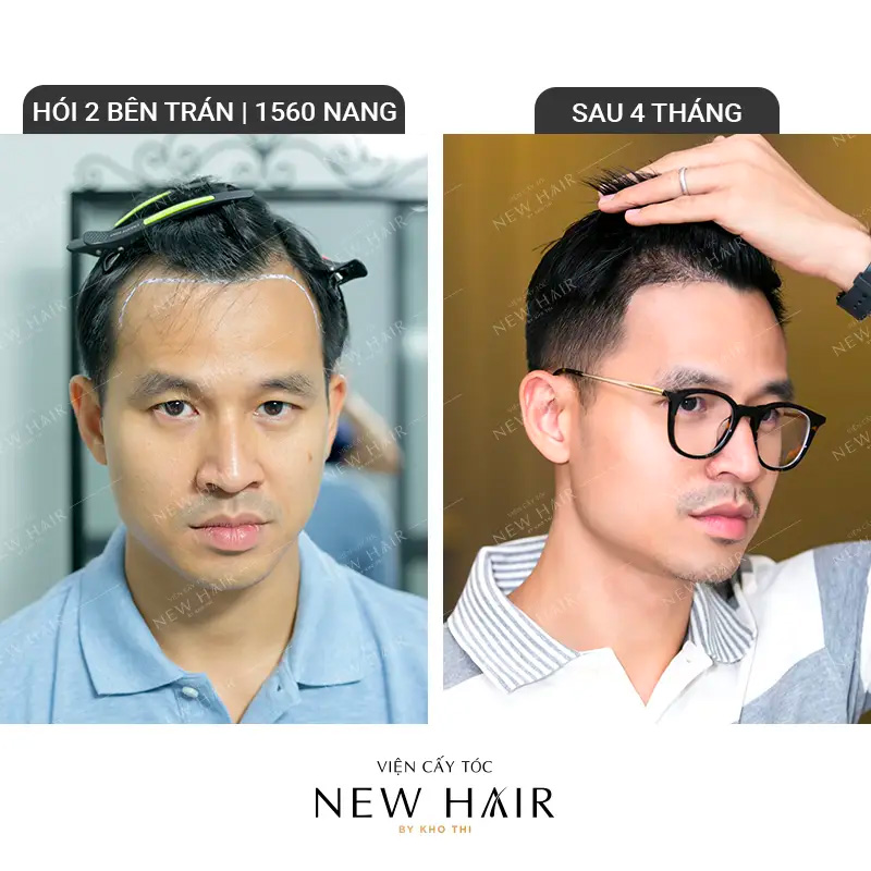 Sau 4 tháng cấy tóc, Sơn Đoàn cho biết tóc của anh tiếp tục phát triển dài và khỏe mạnh