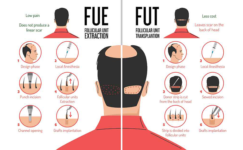 Sự khác biệt của phương pháp cấy tóc FUE và FUT