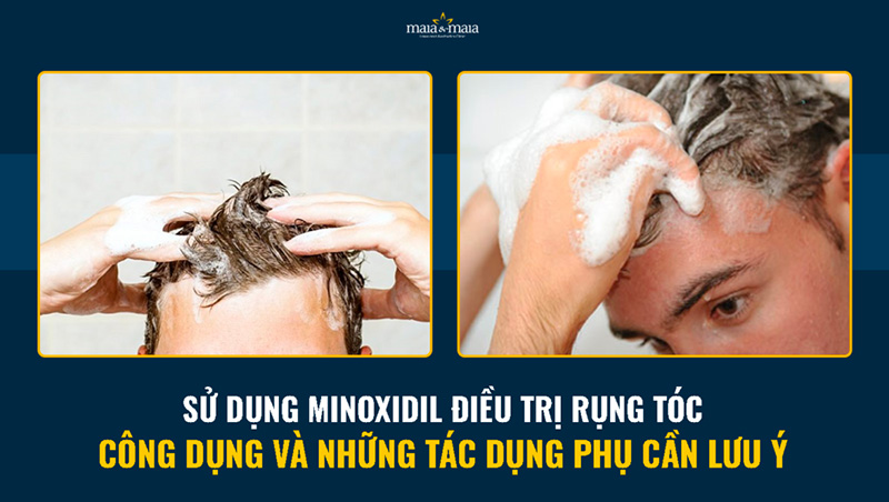 Tác dụng chủ yếu của Minoxidil là kích thích tóc phát triển
