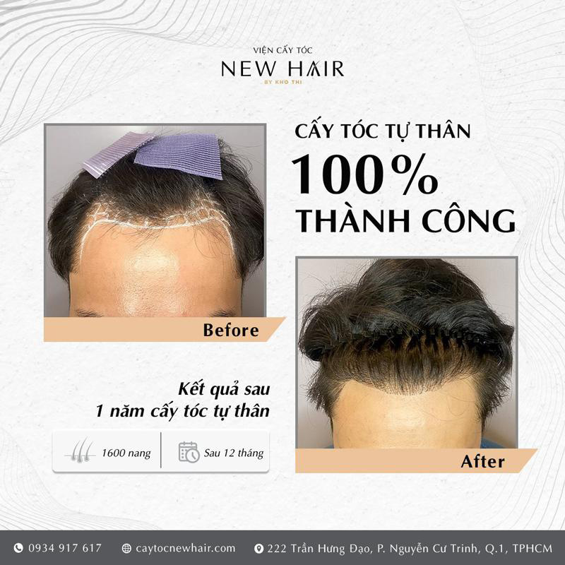 Tóc của khách hàng sau khi cấy tóc tại New Hair