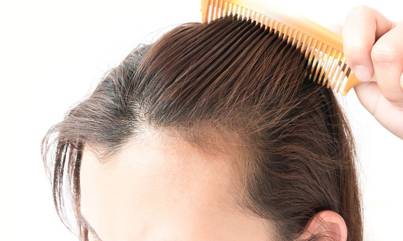 Biểu hiện rõ nhất của hói đầu là tóc rụng