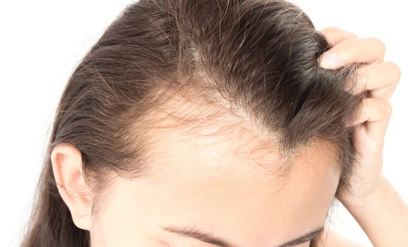 Tuổi càng cao càng dễ bị rụng tóc, hói đầu