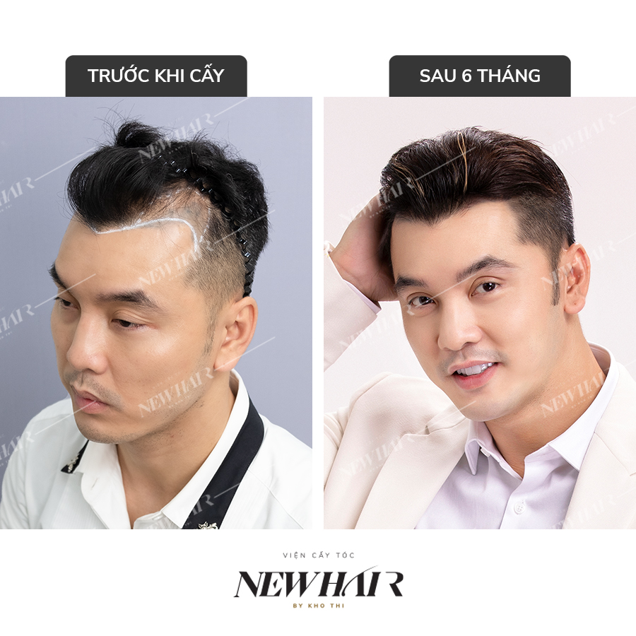 diện mạo của ca sĩ Ưng Hoàng Phúc trước và sau khi cấy tóc tự thân tại New Hair
