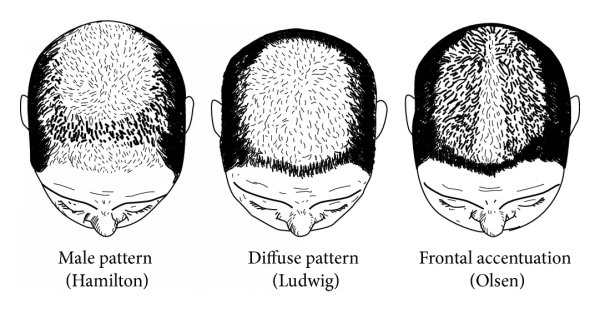 Ba kiểu hói đầu chính ở nữ giới