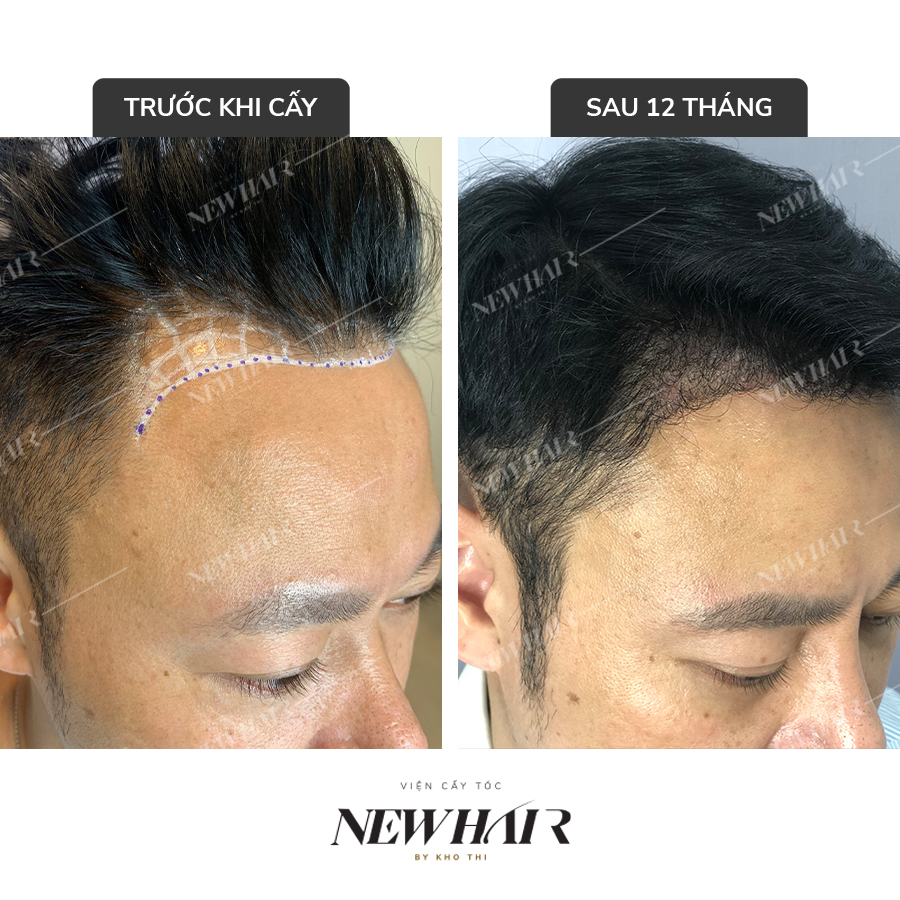 Viện cấy tóc New Hair by Khơ Thị