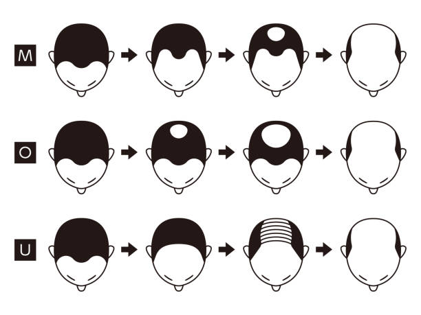 Các giai đoạn hói đầu của 3 dạng hói đầu phổ biến ở nam giới