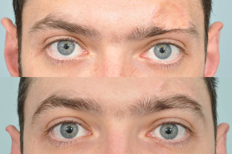 hình ảnh trước và sau khi cấy lông mày
