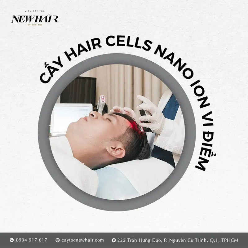 cấy hair cells nano ion vi điểm tại new hair