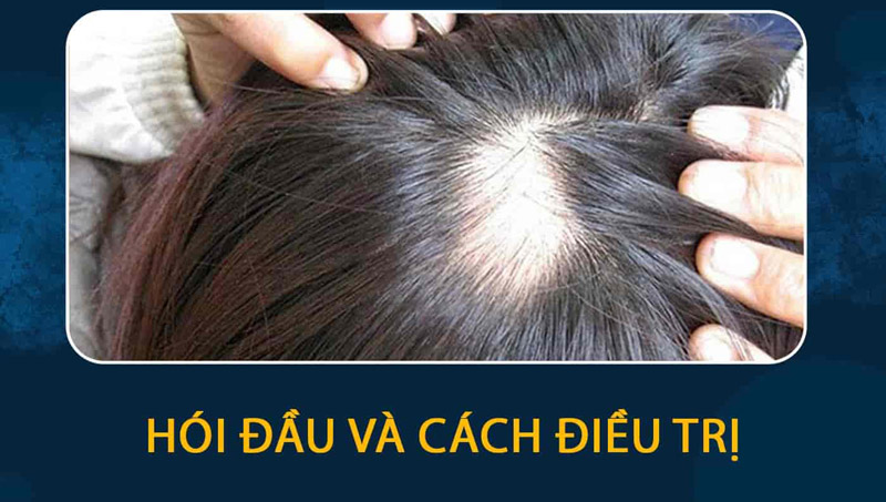 Hói đầu rụng tóc và các biện pháp điều trị hiệu quả