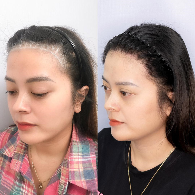 Khách hàng trước và sau khi cấy tóc Hàn Quốc