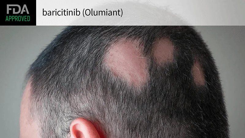 Thuốc Olumiant điều trị chứng rụng tóc từng mảng