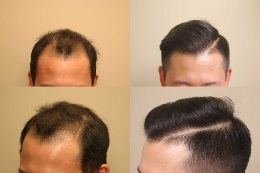 hình ảnh hói tóc và sau khi cấy tóc tự thân ở nam giới
