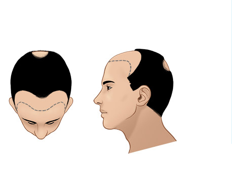 Giai đoạn 4 của hói đầu