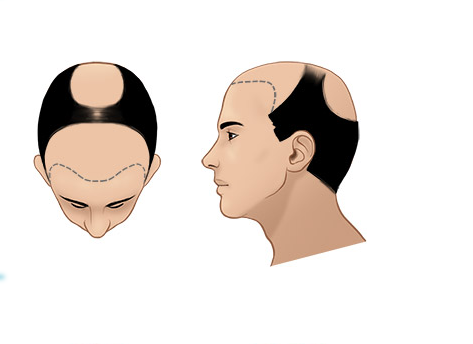 Giai đoạn 6 của hói đầu