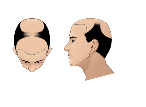 Giai đoạn 7 của hói đầu