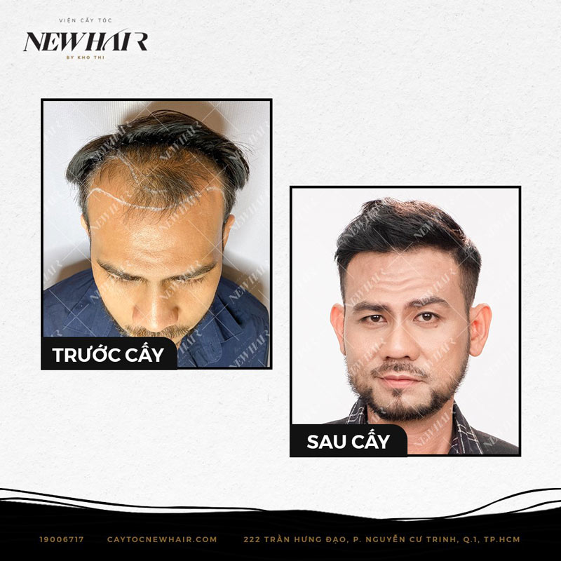 Hình ảnh khách hàng trước và sau khi cấy tóc tự thân tại NEWHAIR