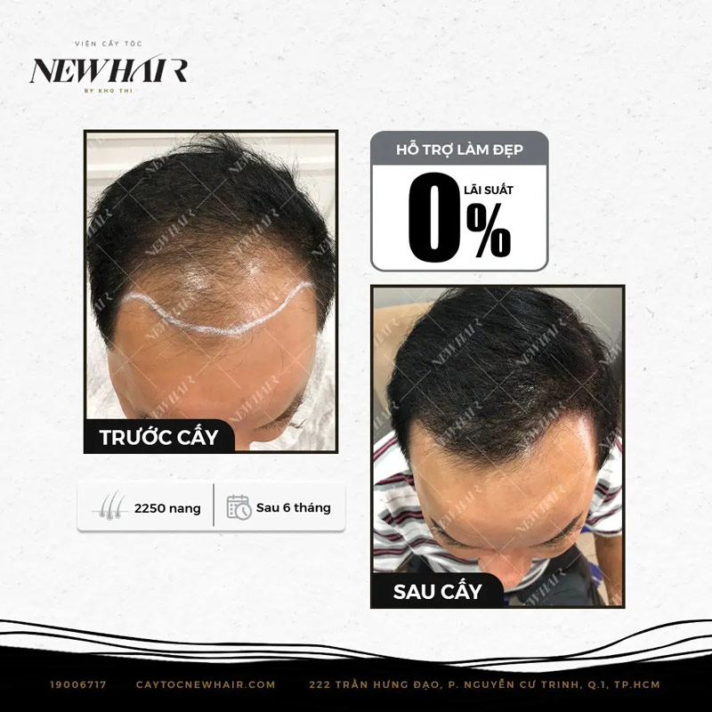hình ảnh tóc của khách trước và sau khi cấy tóc hỗ trợ lãi suất 0% tại new hair
