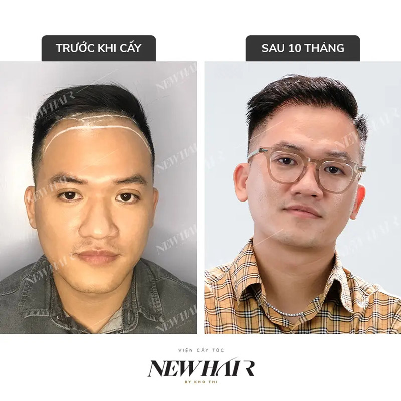 hình ảnh khách hàng trước và sau khi cấy tóc tại new hair
