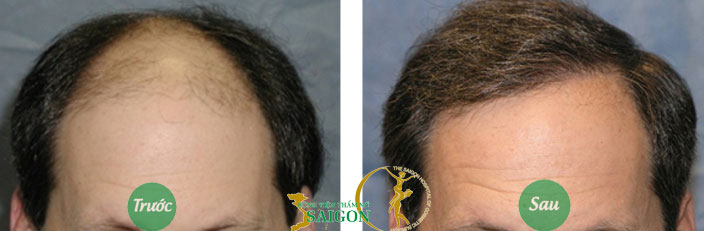 hình ảnh trước và sau khi cấy tóc tại bệnh viện thẩm mỹ sài gòn