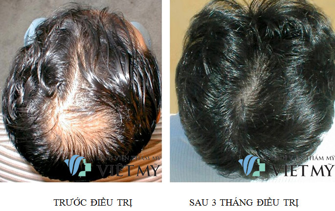 trước và sau cấy tóc tại bệnh viện thẩm mỹ việt mỹ