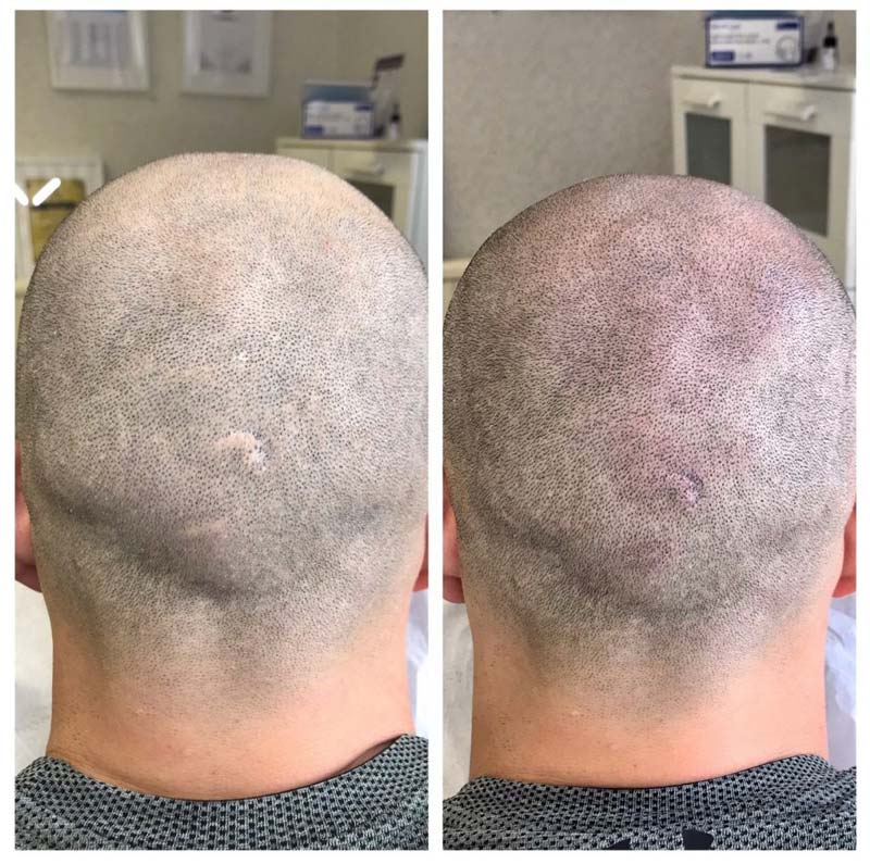 trước và sau khi cấy tóc lên sẹo