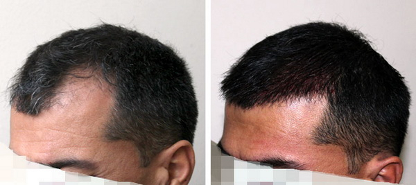 hình ảnh tóc trước và sau cấy tại bệnh viện thẩm mỹ hiệp lợi