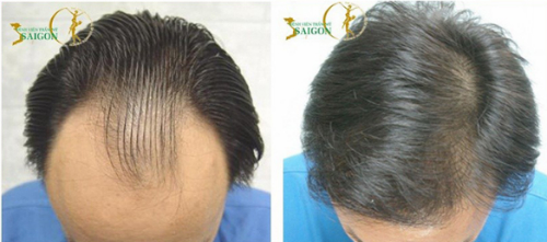 hình ảnh trước và sau cấy tóc tại bệnh viện thẩm mỹ sài gòn