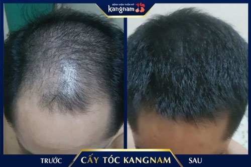hình ảnh trước và sau cấy tóc tại kangnam
