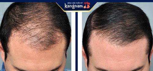 trước và sau cấy tóc tại viện thẩm mỹ kangnam