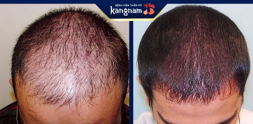 hình ảnh trước và sau khi cấy tóc kangnam