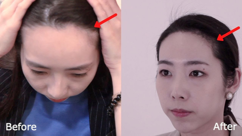 cô gái trước và sau khi cấy tóc tại wonjin