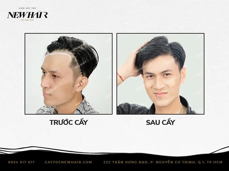 khách hàng trước và sau khi cấy tế bào mầm tóc tại newhair