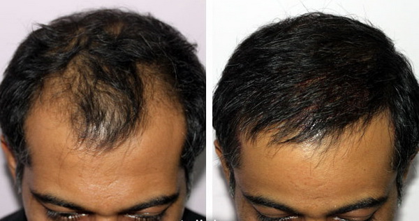hình ảnh trước và sau khi cấy tóc tại bệnh viện thẩm mỹ hiệp lợi