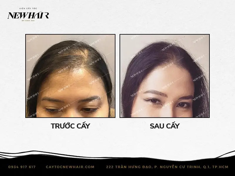 cô gái trước và sau khi cấy tế bào mầm tóc tại newhair