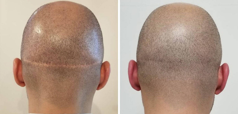 hình ảnh trước và sau khi cấy tóc lên sẹo