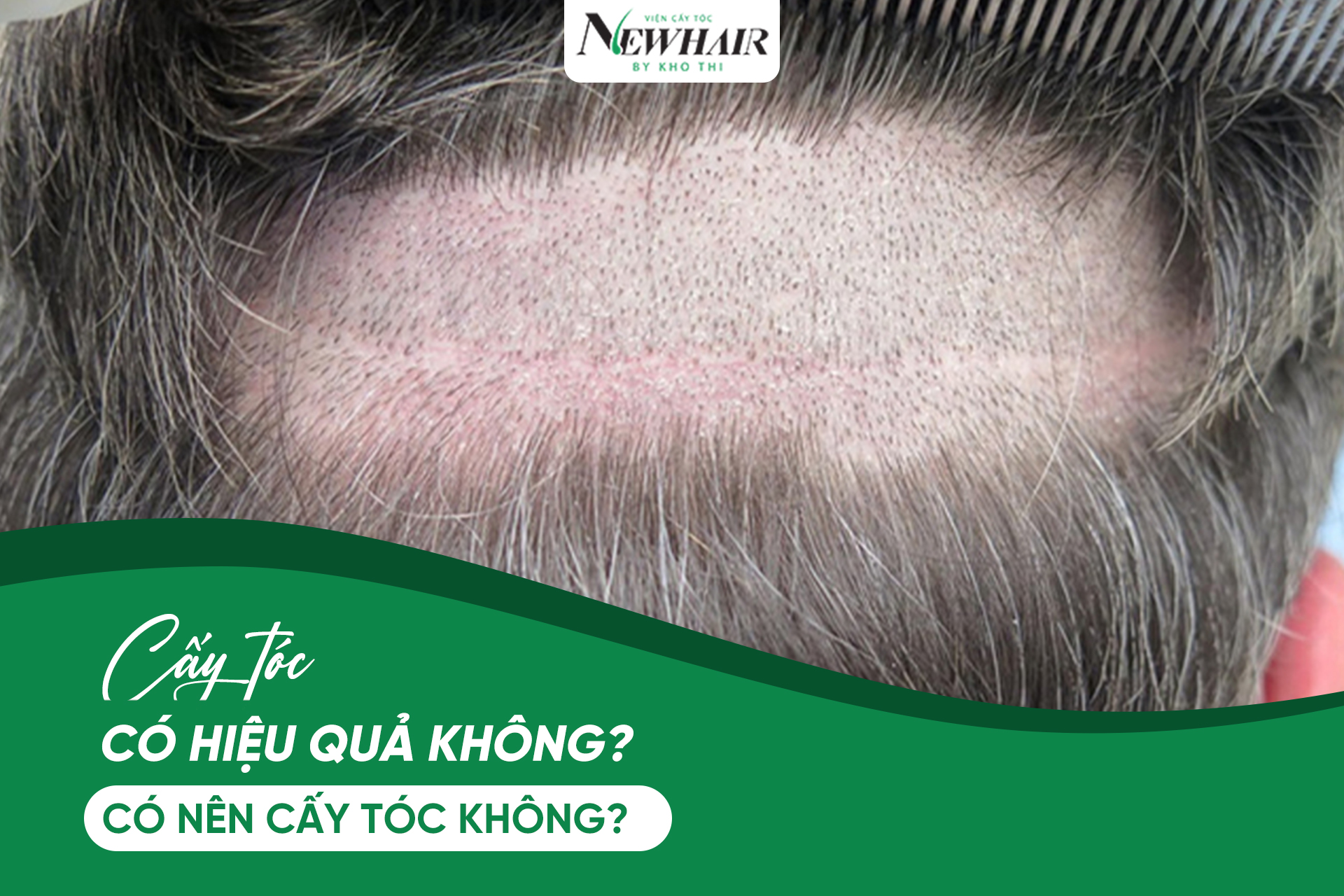 Cấy tóc có hiệu quả không?