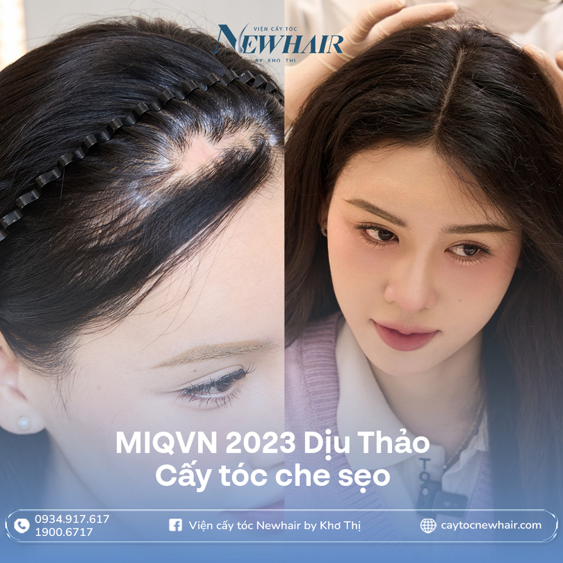 Dịu thảo trước và sau cấy tóc