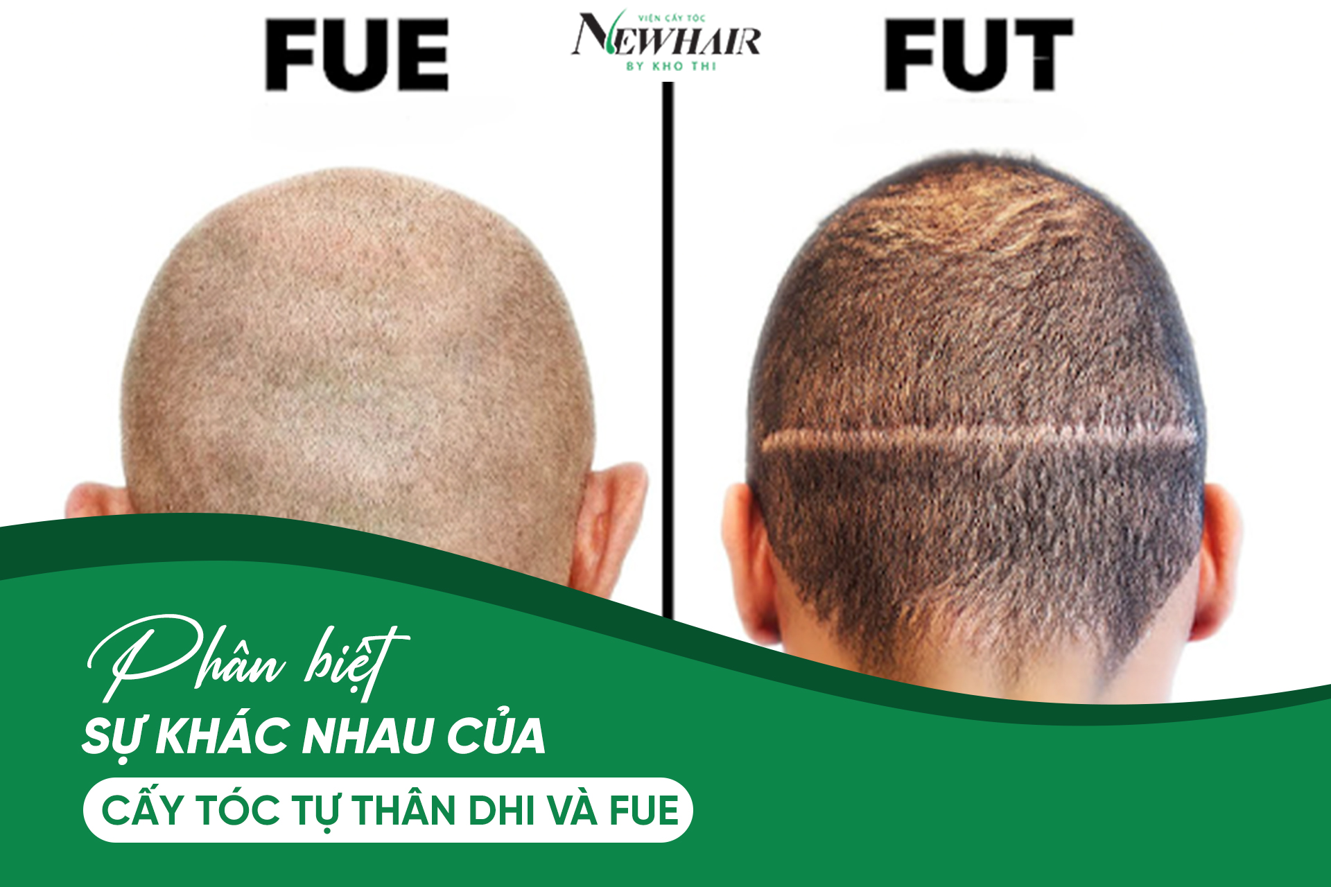 phan biet su khac nhau cua cay toc tu than DHI va FUE