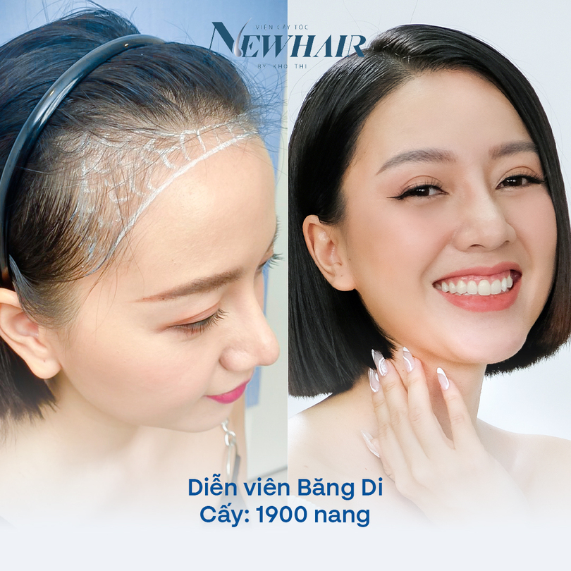 băng di trước và sau khi cấy tóc