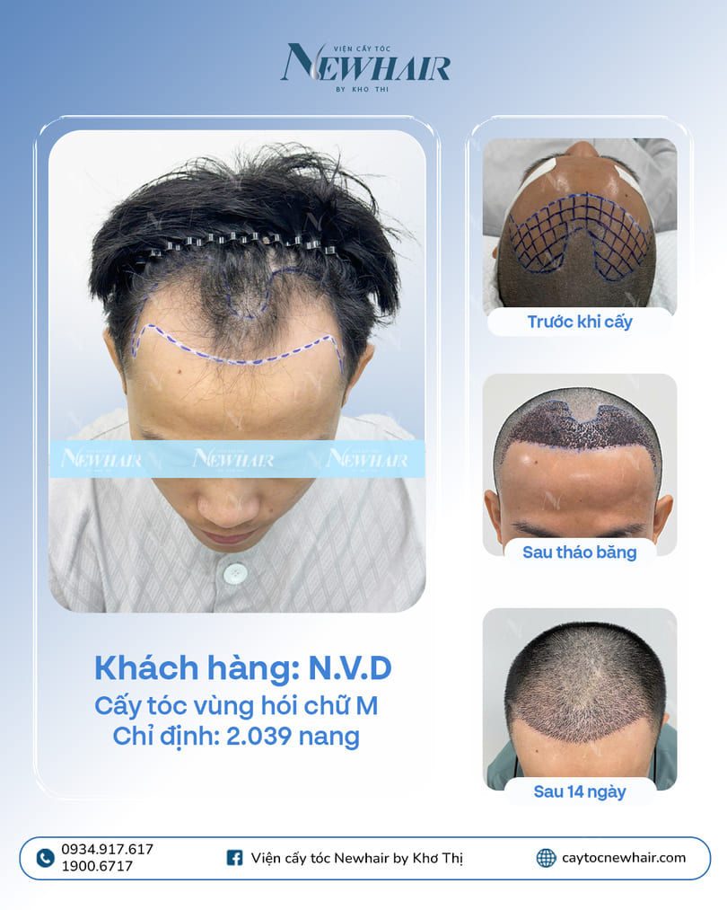 cấy tóc hói chữ m