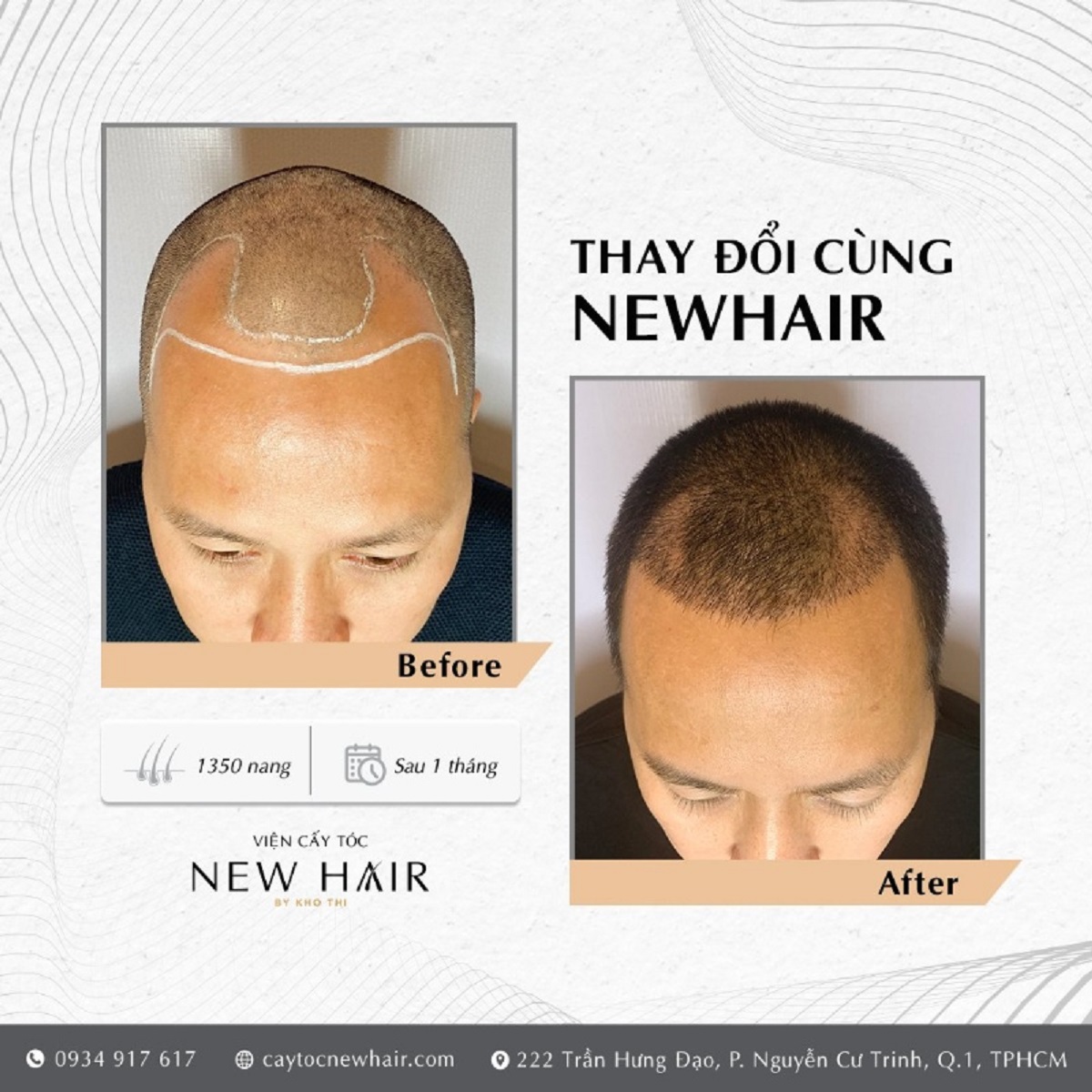 Trung tâm cấy tóc tự thân New Hair giúp khắc phục hói đầu - VnExpress Sức  khỏe