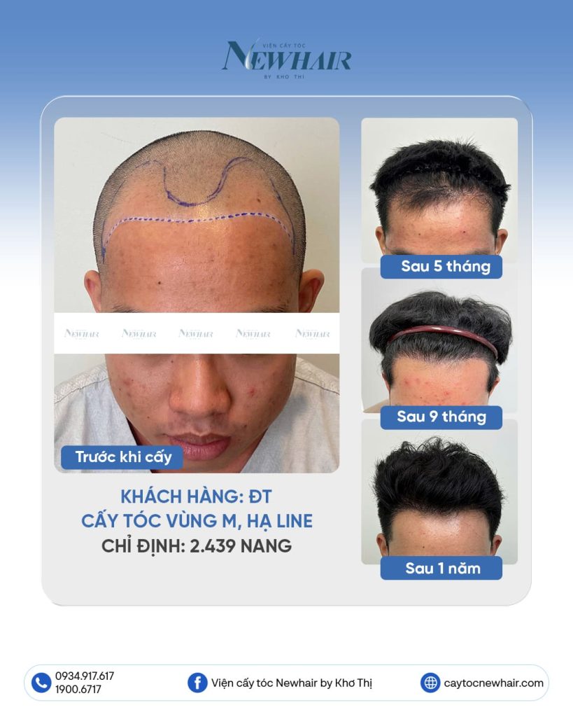 cấy tóc bao nhiêu tiền ở tphcm