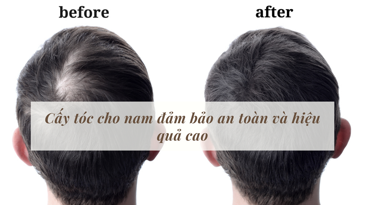 Cấy tóc tự thân tại Black Hair  giải pháp khắc phục hói đầu hiệu quả