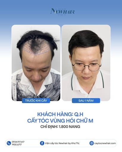 cấy tóc có hiệu quả không