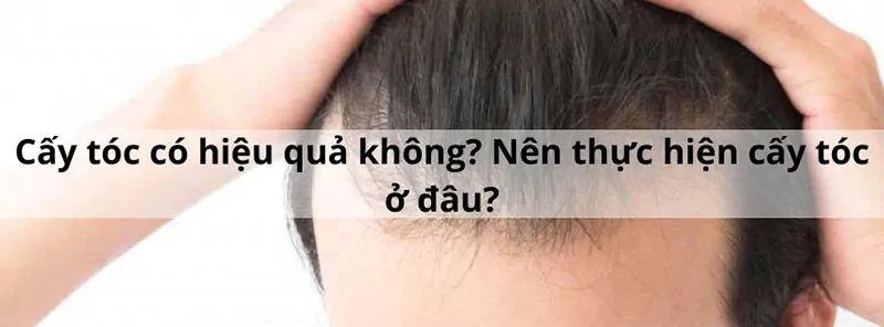 Cấy tóc Hồ Chí Minh ở đâu tốt và hiệu quả được nhiều người lựa chọn