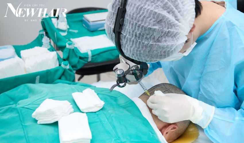 cấy tóc có vĩnh viễn không