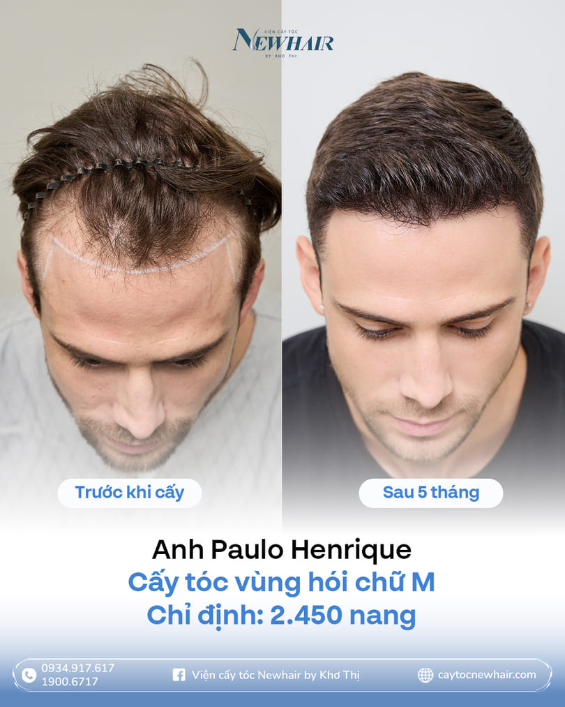 cấy tóc hết bao nhiêu tiền