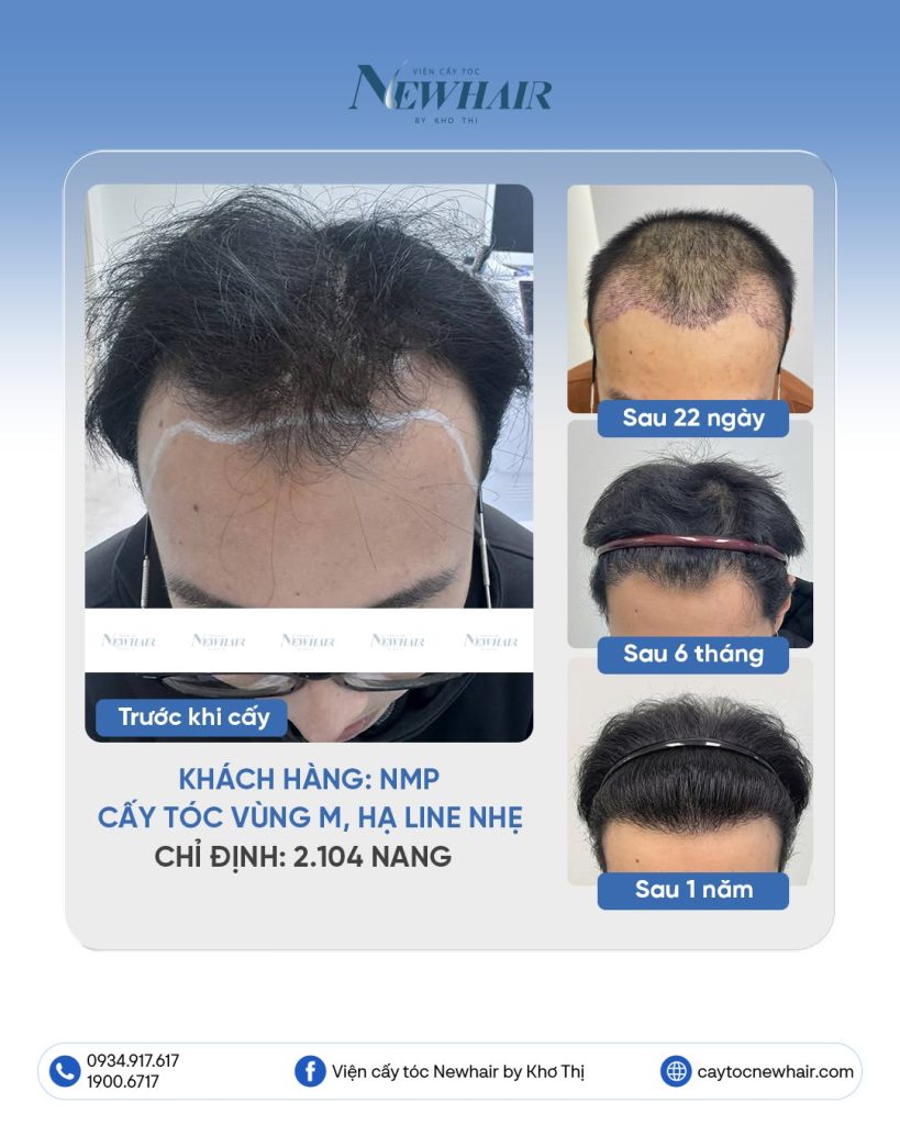cấy tóc hói chữ m sau 1 năm