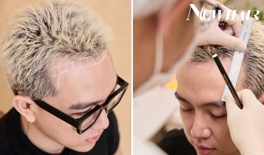 cấy tóc hói chữ m