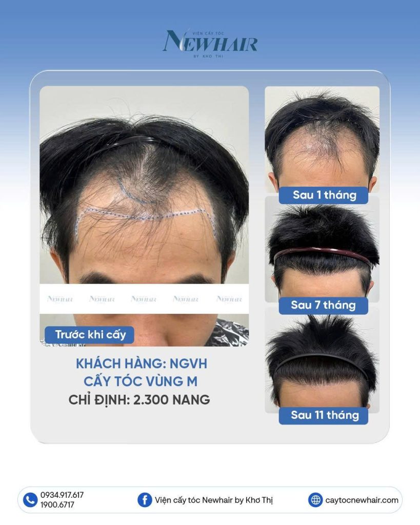 cấy tóc hói chữ M sau 11 tháng